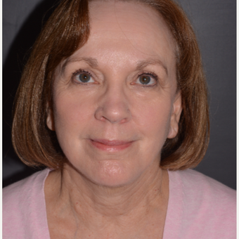 Pre and Post-OP photos of Phenol Croton Oil Peel and Lower Facelift with Submentoplasty after 3108164