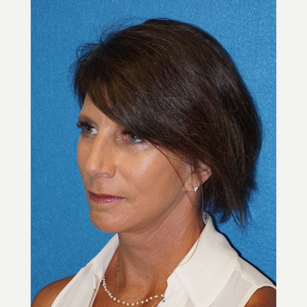 54 year old woman treated with Facelift after 3576636