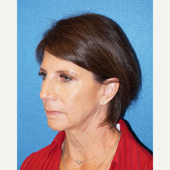 54 year old woman treated with Facelift before 3576636