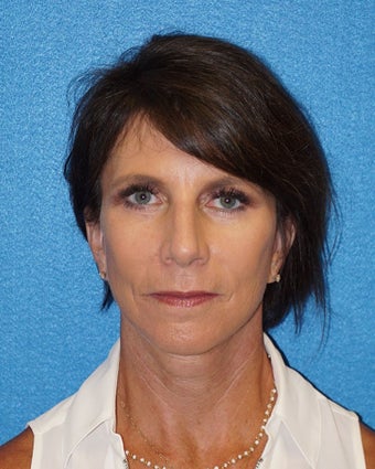 54 year old woman treated with Facelift 3576636