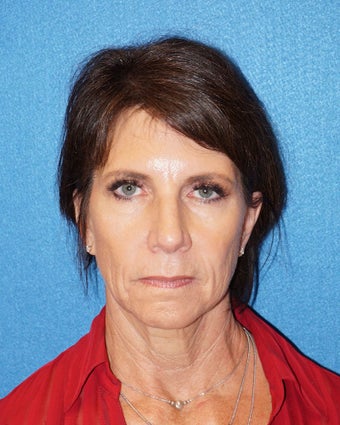 54 year old woman treated with Facelift 3576636