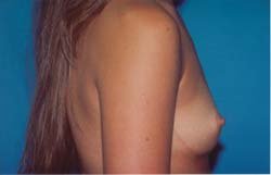 Breast Lift/Augmentation 611038