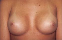 Breast Lift/Augmentation after 611038