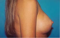 Breast Lift/Augmentation 611038