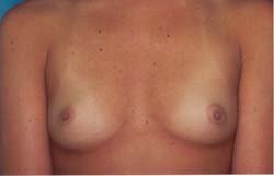 Breast Lift/Augmentation before 611038