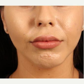 18-24 year old woman treated with Lip Augmentation after 3339290