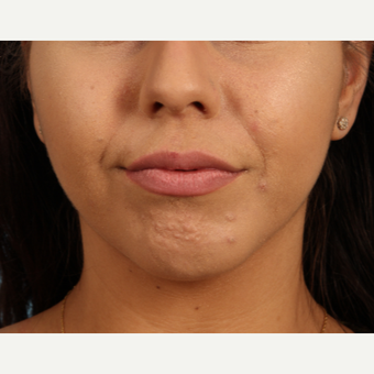 18-24 year old woman treated with Lip Augmentation before 3339290
