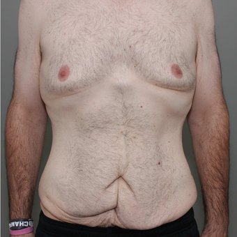 25-34 year old man treated with Tummy Tuck before 3069738