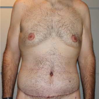 25-34 year old man treated with Tummy Tuck after 3069738