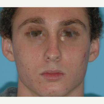 19 year old male after rhinoplasty 3324021