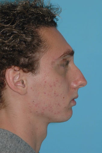 19 year old male after rhinoplasty before 3324021