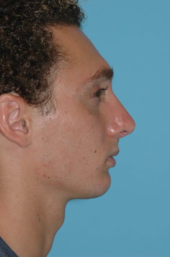 19 year old male after rhinoplasty after 3324021