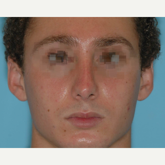 19 year old male after rhinoplasty 3324021