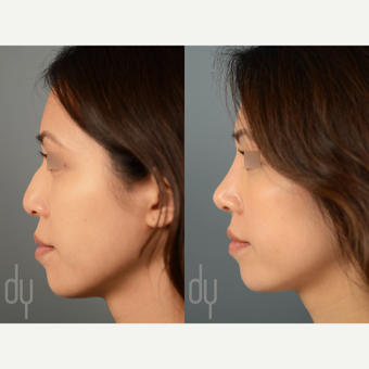 Asian Rhinoplasty with DCF before 3129942