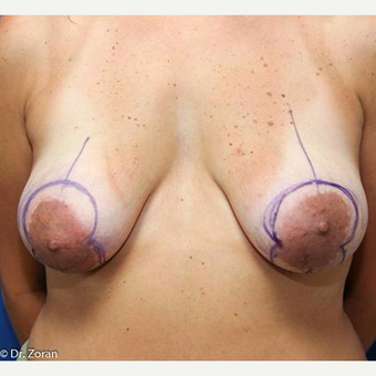 25-34 year old woman treated with Breast Lift with Implants before 3032942