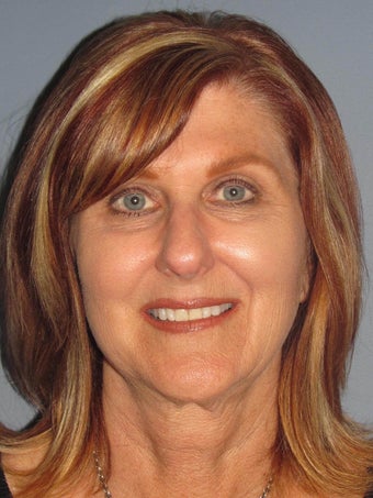 Blue Peel®, LiteLift™, Platysmaplasty on 57-year-old Woman before 1149667
