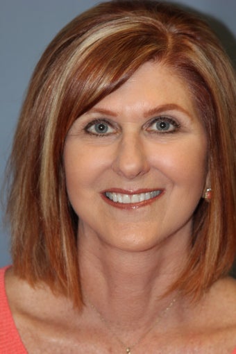 Blue Peel®, LiteLift™, Platysmaplasty on 57-year-old Woman after 1149667