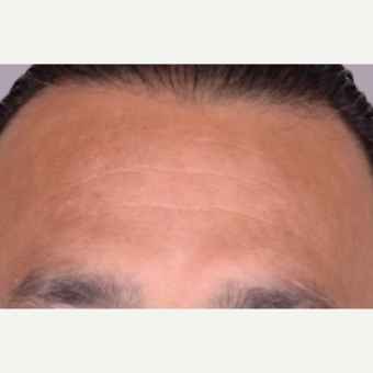 45-54 year old man treated with NeoGraft before 2030287