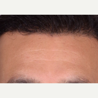 45-54 year old man treated with NeoGraft after 2030287