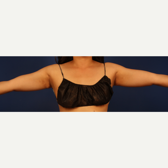 Liposuction before 3743858