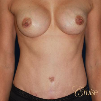 Mother of five underwent a standard tummy tuck after 3584892