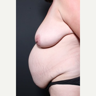 25-34 year old woman treated with Tummy Tuck before 3844700