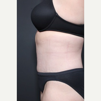 25-34 year old woman treated with Tummy Tuck after 3844700