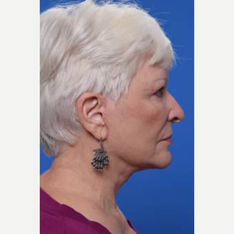 QuickLift (mini-lift) after 2093624