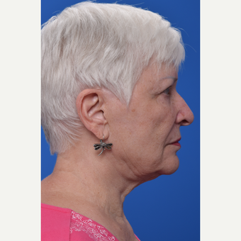 QuickLift (mini-lift) before 2093624