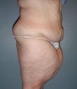 Female patient who underwent a thigh lift 925313