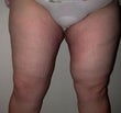 Female patient who underwent a thigh lift after 925313