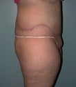 Female patient who underwent a thigh lift 925313