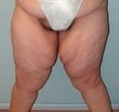 Female patient who underwent a thigh lift before 925313
