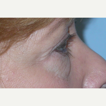 45-54 year old woman treated with Eyelid Surgery before 3074607
