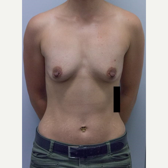 25-34 year old woman treated with Breast Augmentation before 3177013