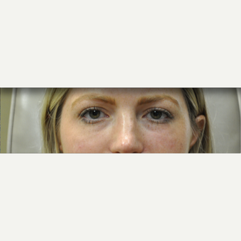 25-34 year old woman treated with Restylane after 3182059