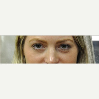 25-34 year old woman treated with Restylane before 3182059