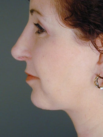 Female Chin Implant after 831889
