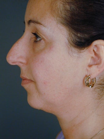 Female Chin Implant before 831889
