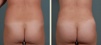 Butt Augmentation before 1377677