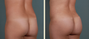 Butt Augmentation after 1377677