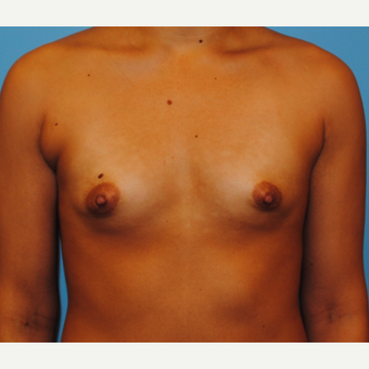 25-34 year old woman treated with Breast Implants before 3076396