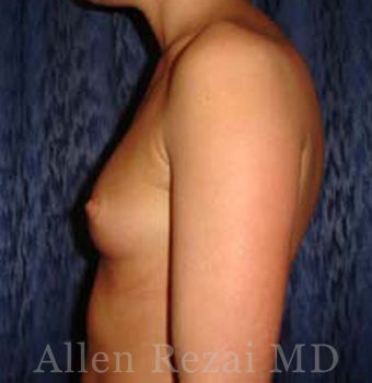 Bilateral Breast Augmentation - Pre- & 16 Months Post-op 2255192