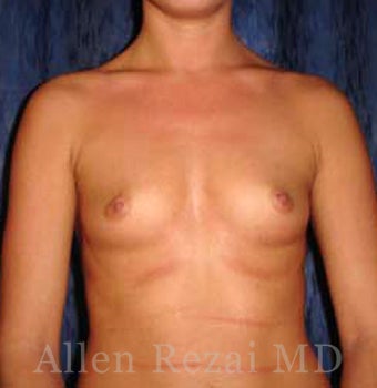 Bilateral Breast Augmentation - Pre- & 16 Months Post-op before 2255192