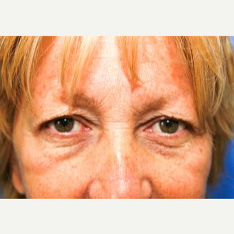 55-64 year old woman treated with Eyelid Surgery before 3093823