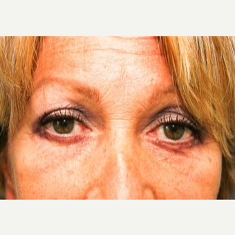 55-64 year old woman treated with Eyelid Surgery after 3093823