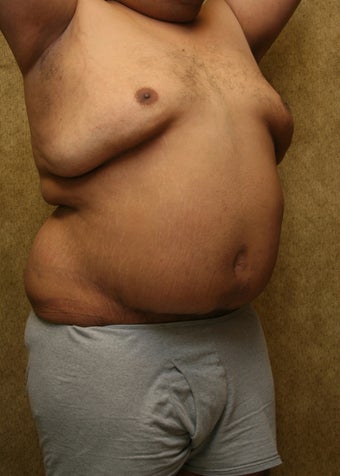 tummy tuck with liposuction of abdomen after 948721