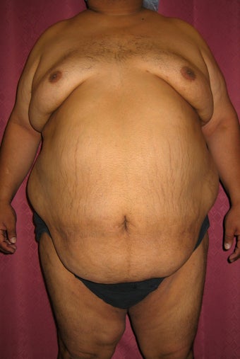 tummy tuck with liposuction of abdomen 948721
