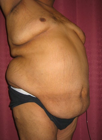 tummy tuck with liposuction of abdomen before 948721