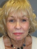 65-74 year old woman treated with Neck Lift before 3103924